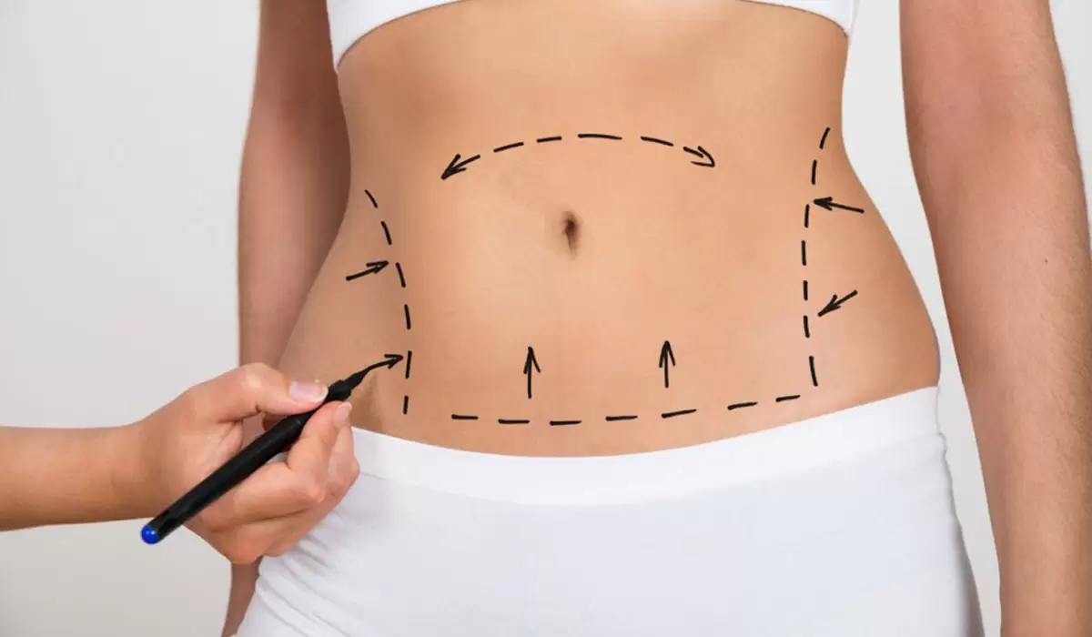 ما هي مدة عملية شفط الدهون بالليزر