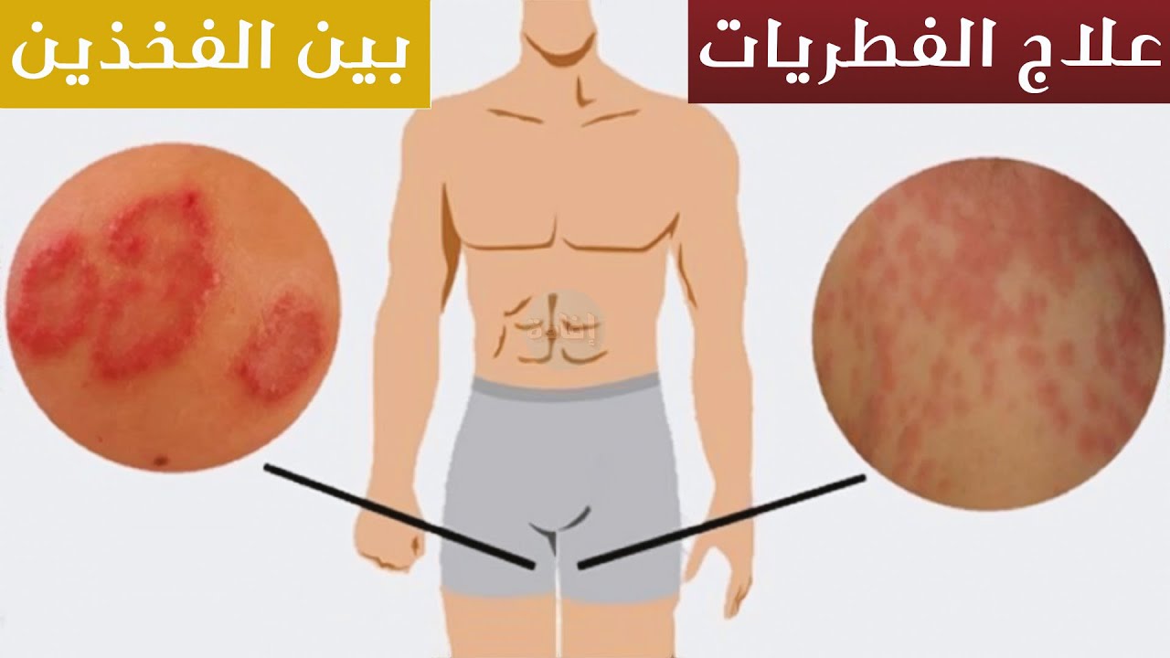 علاج الفطريات الجلدية في المناطق الحساسة وأنواعها