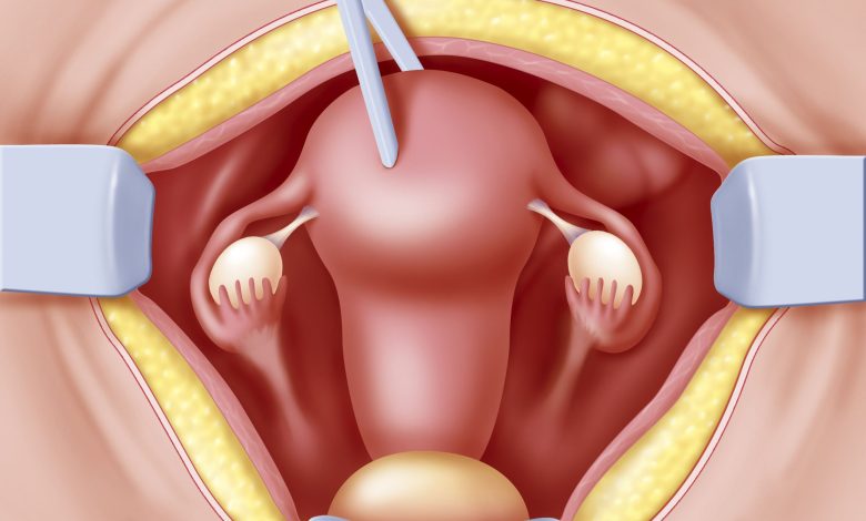 عملية استئصال الرحم المهبلي