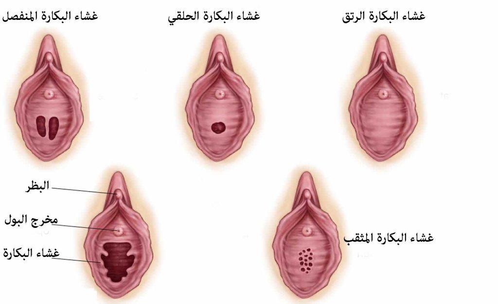 شكل غشاء بكارة هلالي سليم