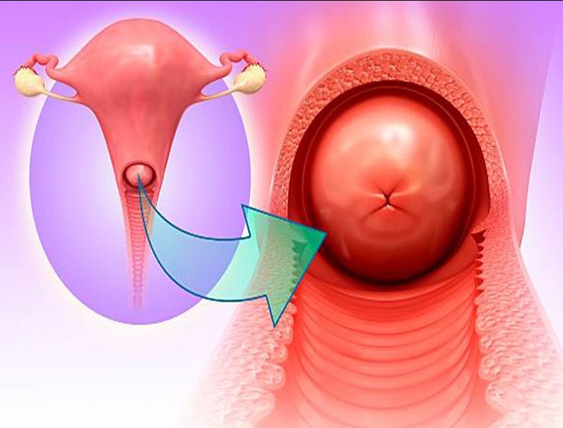 هل قرحة الرحم تمنع الحمل.